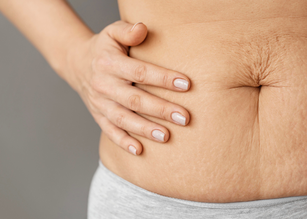 Stretch Marks After Tummy Tuck: Can They Be Avoided?