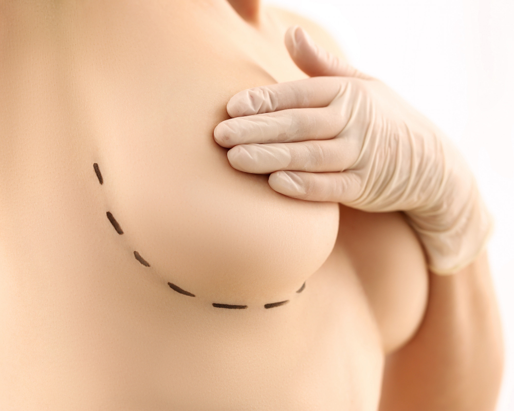 Breast Augmentation with Lift vs. Implants Alone: Which Option Is Best for You?